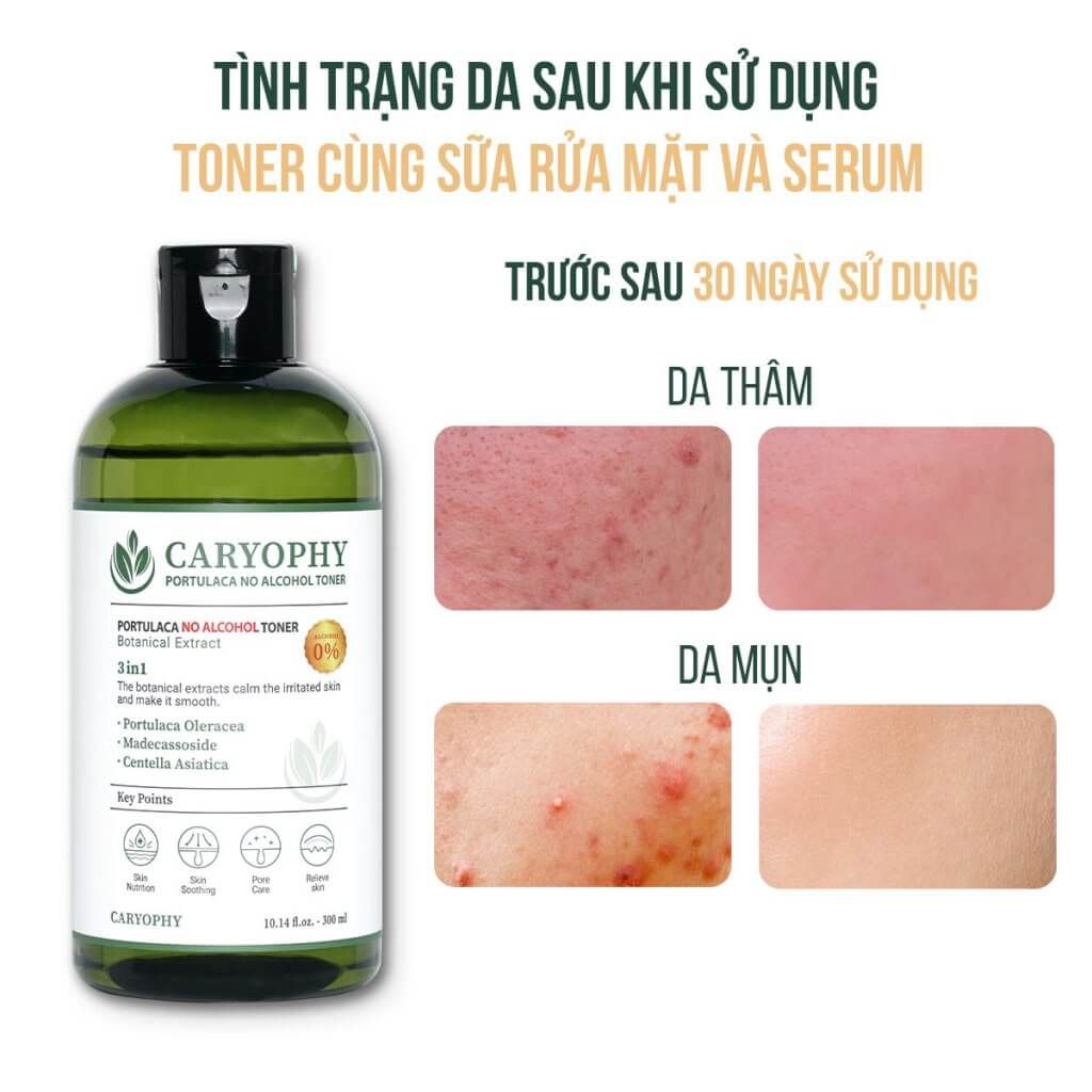 Nước Hoa Hồng Chăm Sóc Da Dầu Mụn Caryophy Portulaca Toner 300ml