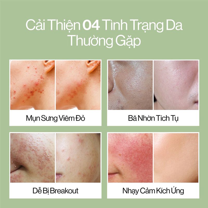 Kem Dưỡng Chiết Xuất Khổ Qua & B5 Giúp Cải Thiện Da Mụn Gilaa Bitter Melon Blemish Repair Cream 50ml