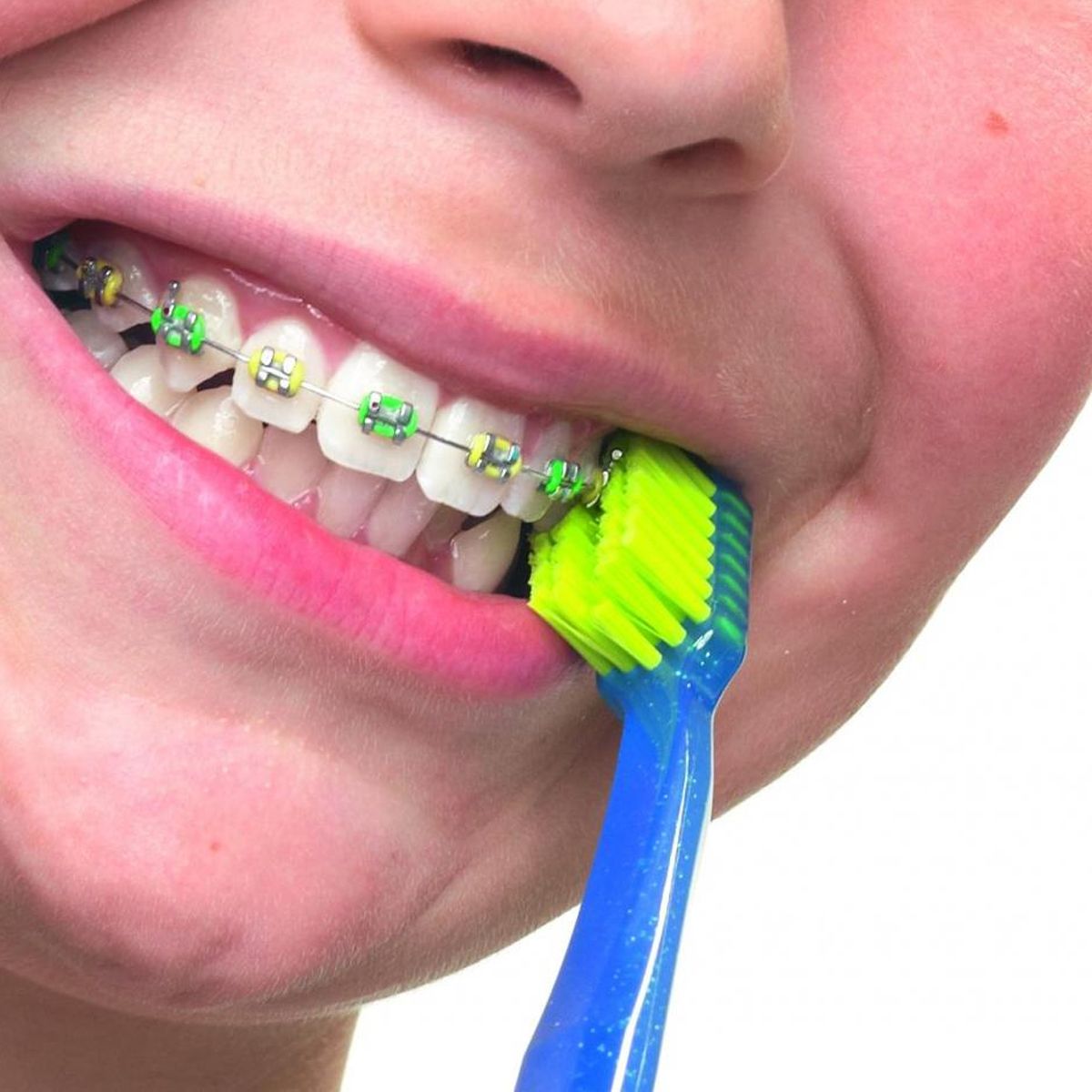Bàn chải răng Curaprox CS 5460 Ortho cho răng niềng