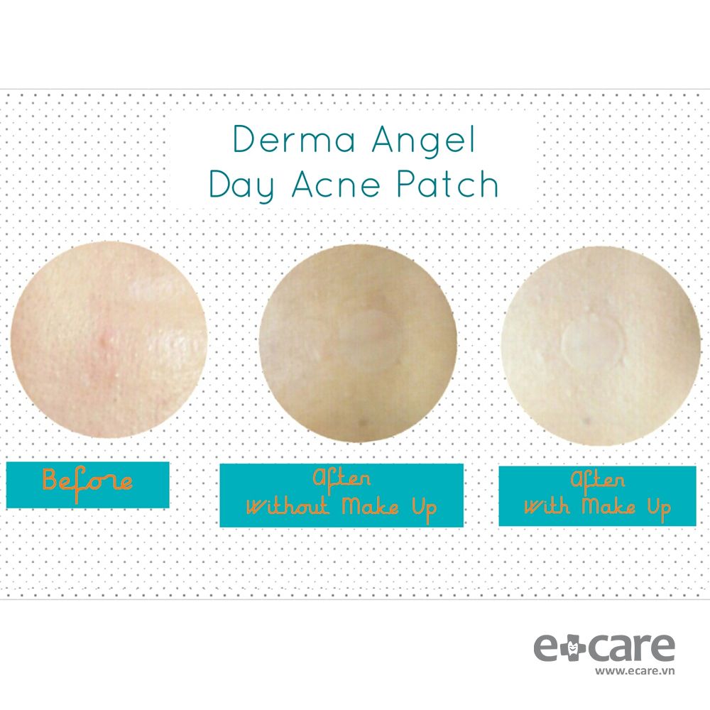 Miếng dán trị mụn Derma Angel dùng ban đêm 12 miếng