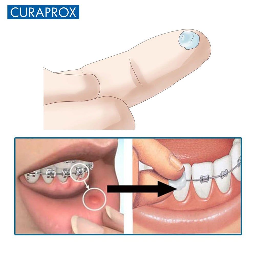 Sáp nha Curaprox Ortho Wax cho răng niềng