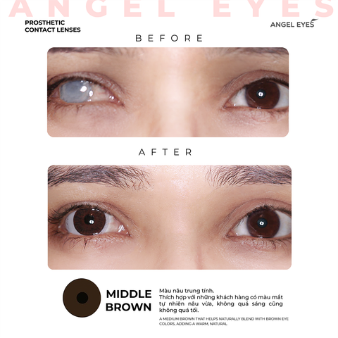 Kính áp tròng thẩm mỹ - Kính áp tròng che khuyết điểm