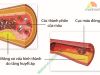 Viên Uống Hỗ Trợ Phòng Đột Quỵ Natto Kinase 2000 FU Orihiro Nhật Bản