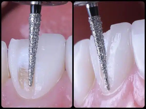 Mũi mài kim cương hạt siêu thô Mani Nhật Bản (Vỉ 5 cây)