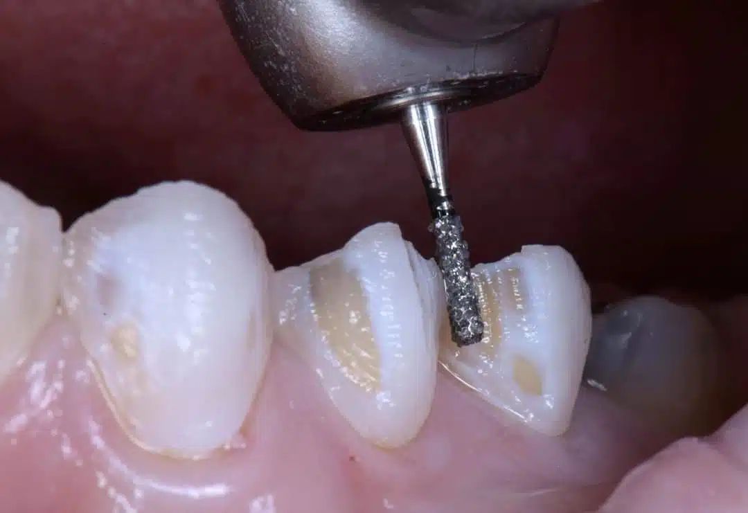 Mũi mài kim cương hạt siêu thô Mani Nhật Bản (Vỉ 5 cây)