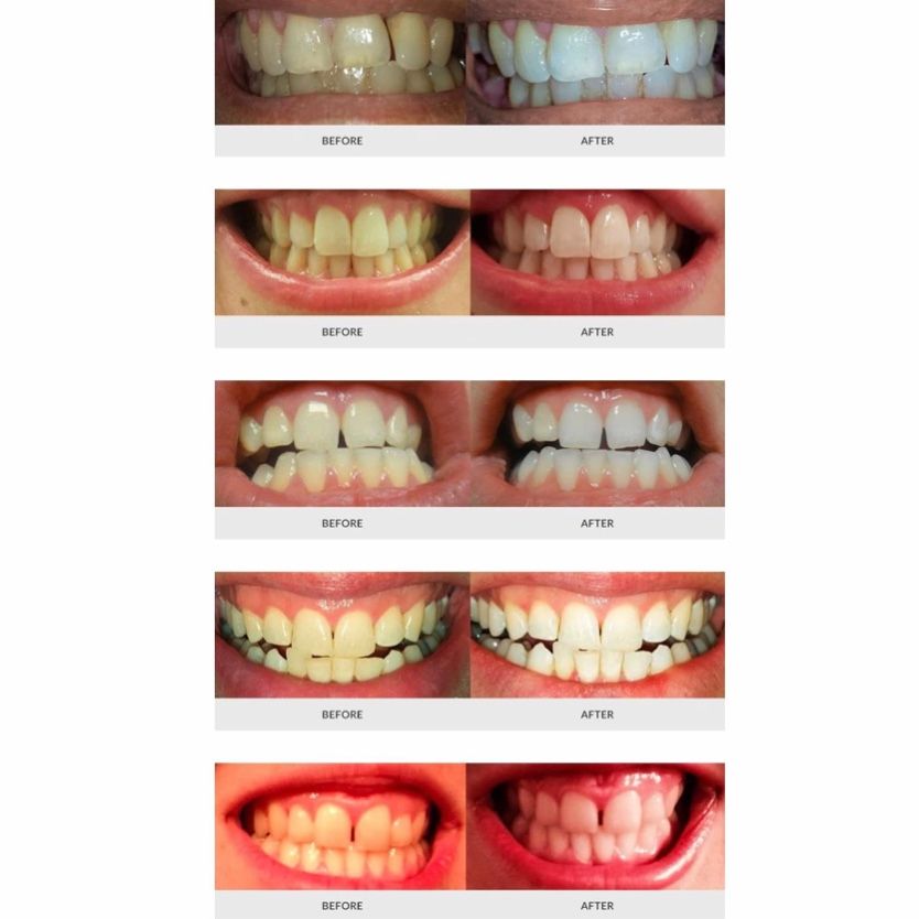 Máy làm trắng răng AuraGlow Teeth Whitening Kit LED Light