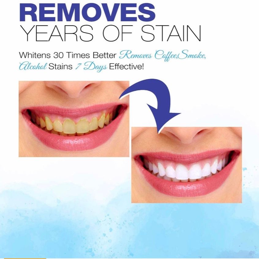 Máy làm trắng răng VieBeauti Teeth Whitening Pen(2 Pcs)