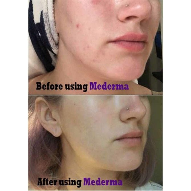 Gel trị sẹo Mederma Advanced Scar - Hàng Canada
