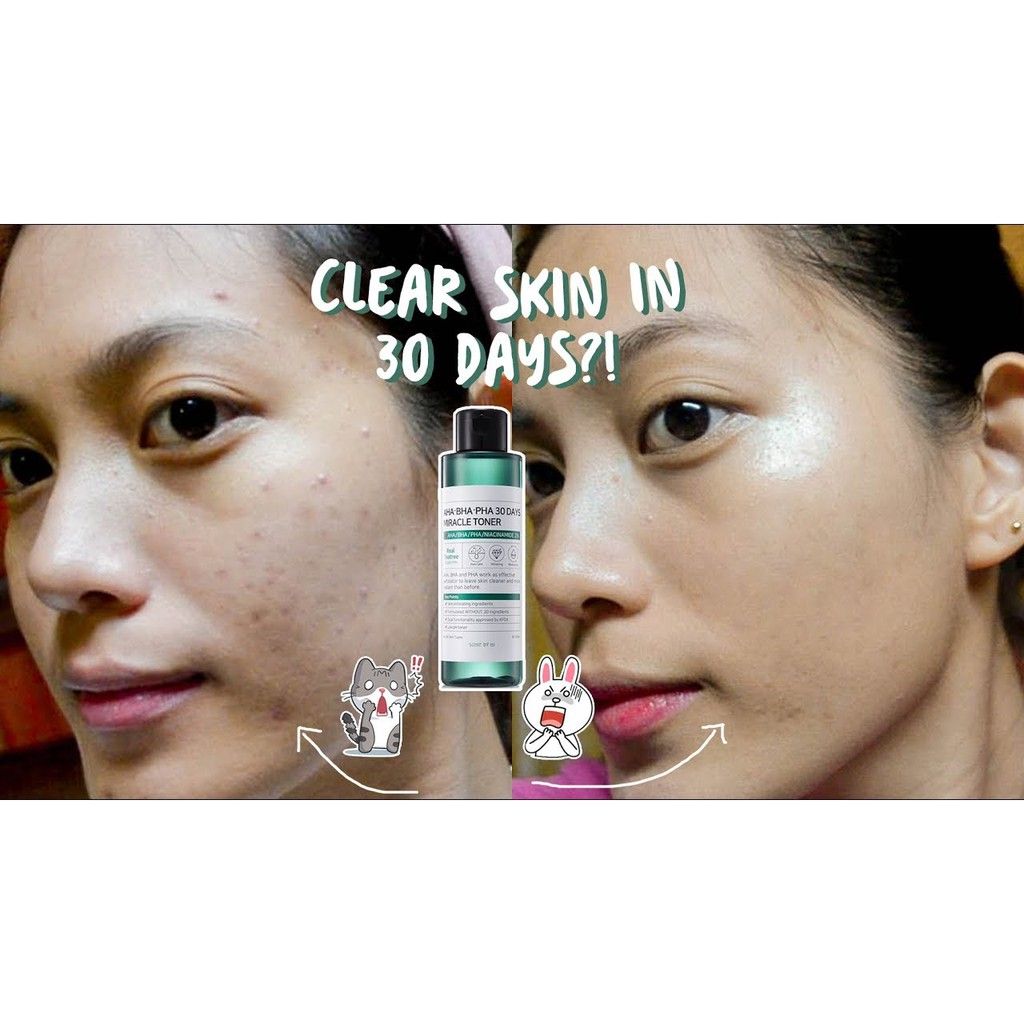 Nước hoa hồng Some By Mi Miracle Toner AHA BHA PHA 30 ngày dưỡng ẩm loại bỏ mụn 150ml