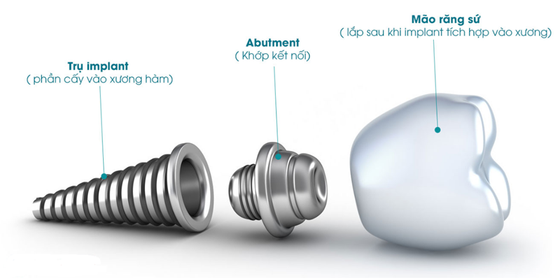 vi-sao-can-trong-rang-implant-01