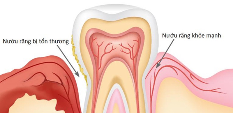 nuou-rang-bi-ton-thuong