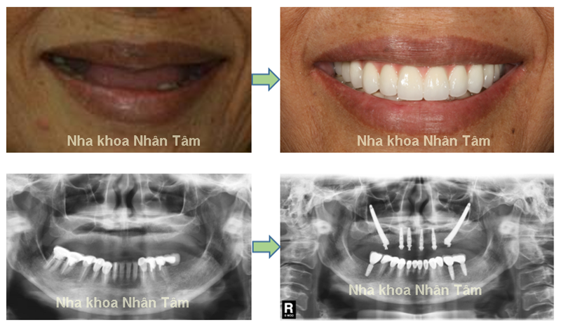 quy-trinh-trong-rang-implant-002