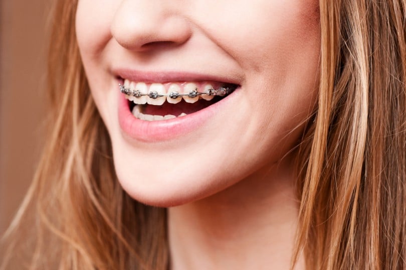 How long does it take to wear Braces ? Nha Khoa Nhân Tâm