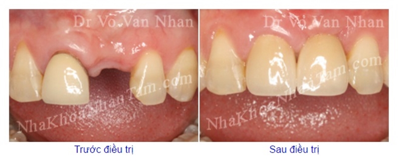 cay-ghep-implant-nha-khoa-sau-nho-rang-5