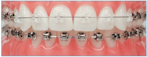 Rang-mom-va-cach-dieu-tri