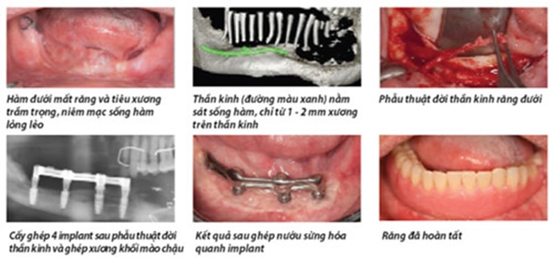 doi-day-than-kinh-ham-duoi-de-cay-implant-nha-khoa-2