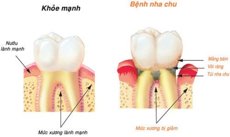 Nha-chu-benh-nguy-hiem-trong-nha-khoa-2