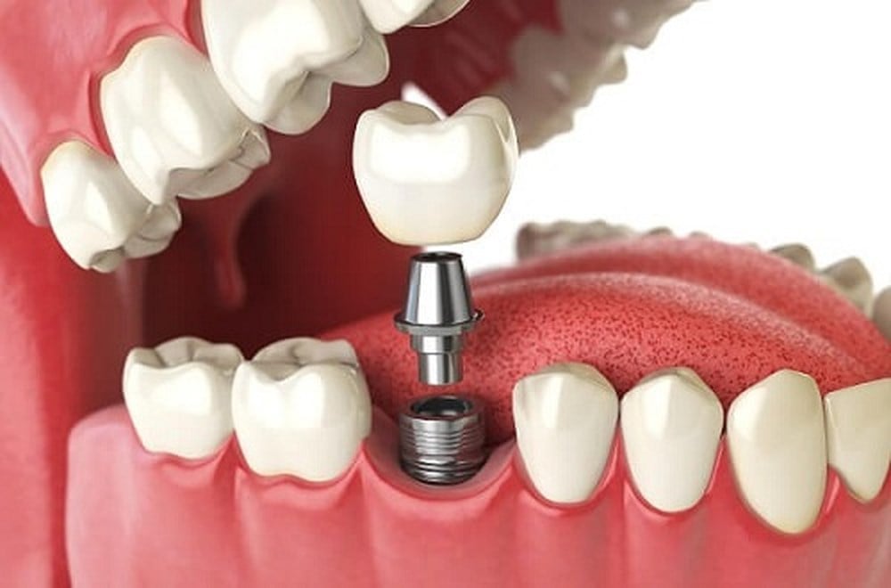 Kết quả hình ảnh cho phục hình răng sứ trên implant