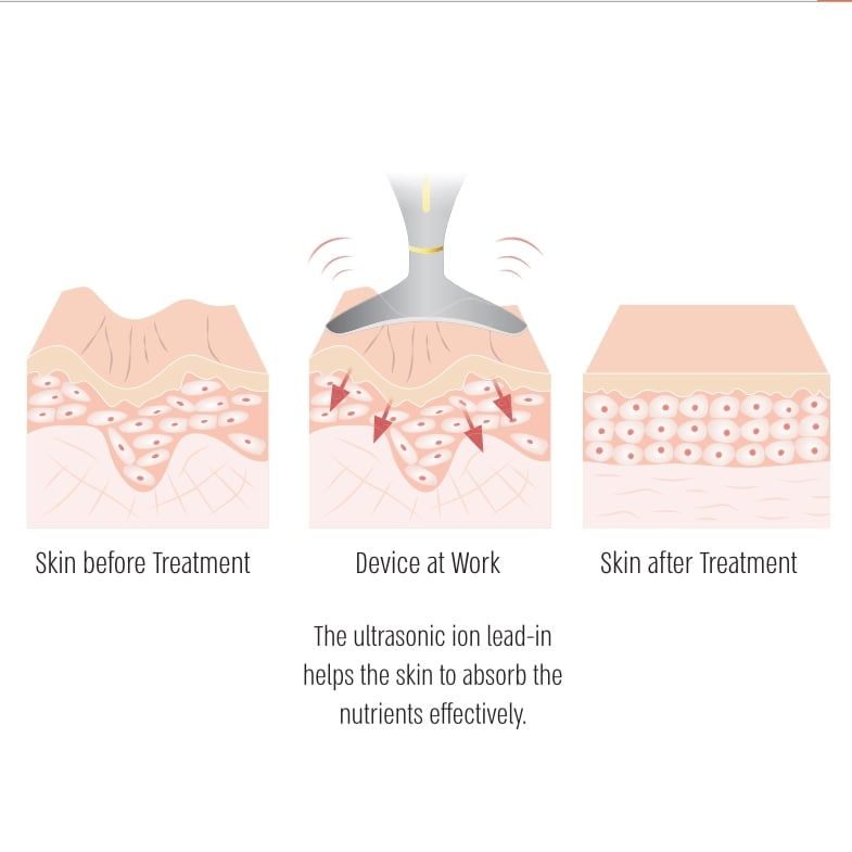 MÁY CỔ AECOR BẠC – AECOR NECK DEVICE