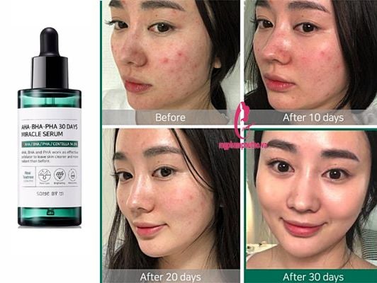 Tinh chất Serum trị mụn Some By Mi AHA-BHA-PHA 30 Days