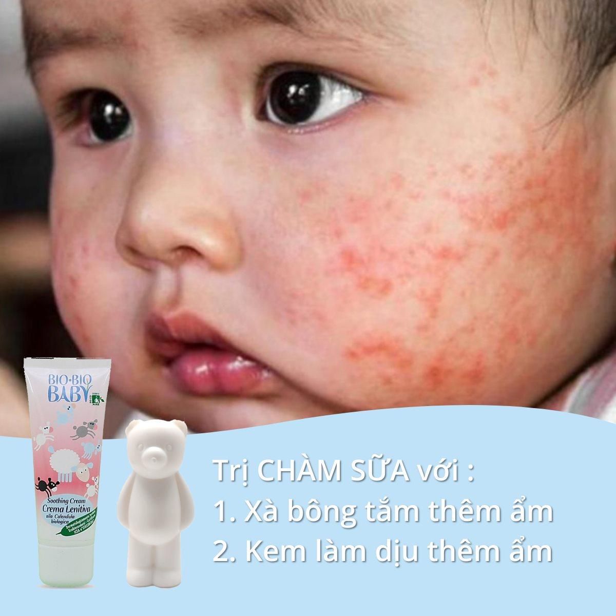 E.M Combo kem trị chàm sữa Bio Bio Baby
