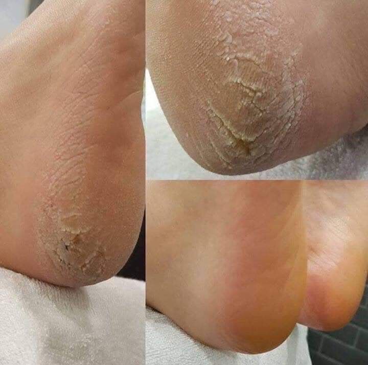 Dụng cụ chà gót chân Balea