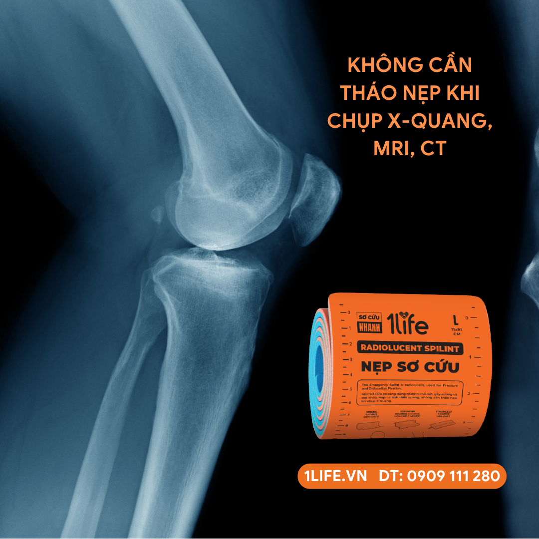 NẸP SƠ CỨU THẤU QUANG - RADIOLUCENT SPLINT - NẸP CAM, NẸP SAM