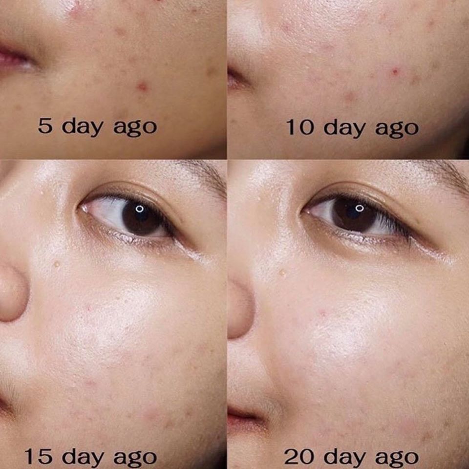Bộ Kit trị mụn 30 ngày SOME BY MI AHA - BHA - PHA 30 DAYS MIRACLE AC SOS KIT (4 món) (không tích điểm)