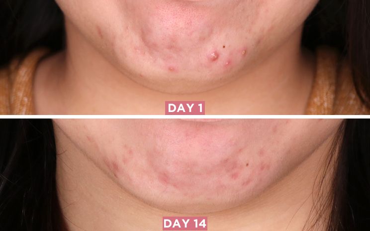 Bộ Kit trị mụn 30 ngày SOME BY MI AHA - BHA - PHA 30 DAYS MIRACLE AC SOS KIT (4 món) (không tích điểm)