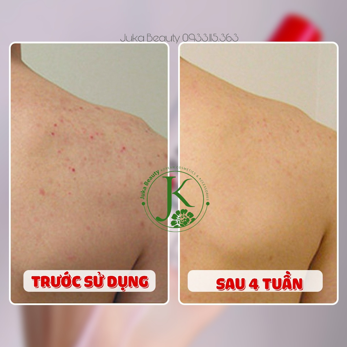 Sữa Dưỡng Thể Giảm Mụn, Dưỡng Trắng Tiam Anti-Blemish Body Lotion 200ml