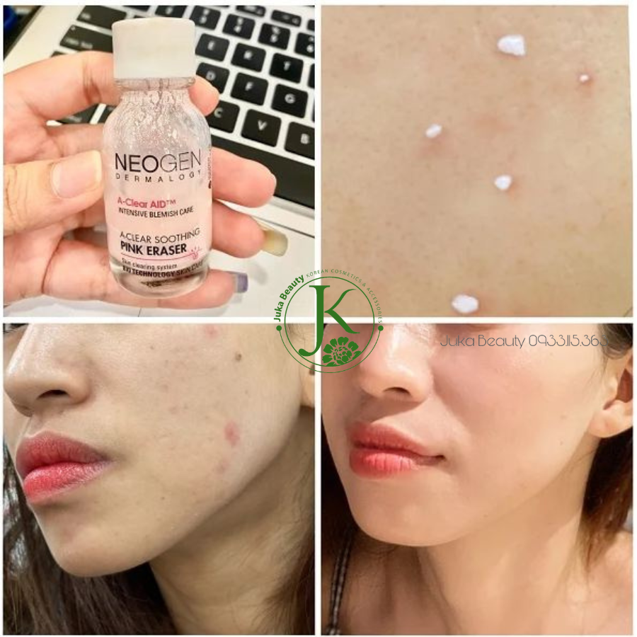 Tinh Chất Chấm Mụn Neogen Dermalogy A- Clear Aid Soothing Pink Eraser 15ml