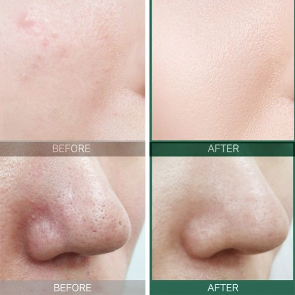 Bộ Kit trị mụn 30 ngày SOME BY MI AHA - BHA - PHA 30 DAYS MIRACLE AC SOS KIT (4 món) (không tích điểm)