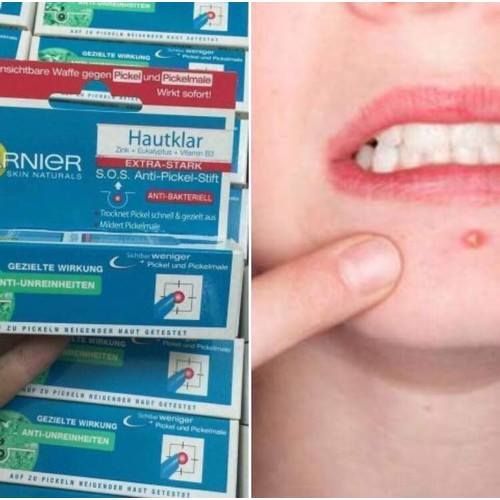 BÚT TRỊ MỤN TRỨNG CÁ SIÊU NHANH VÀ HIỆU QUẢ - GANIER.