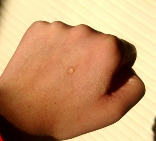 KEM TRỊ MỤN ẨN CỦA DERMIDIC