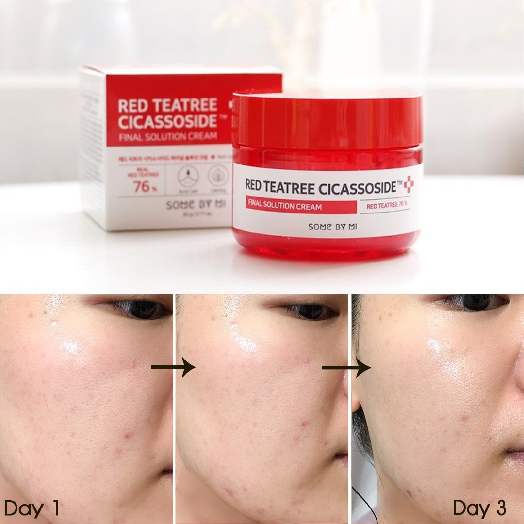  Kem Dưỡng Giảm Mụn Some By Mi Red Teatree Cicassoside Final Solution Cream 