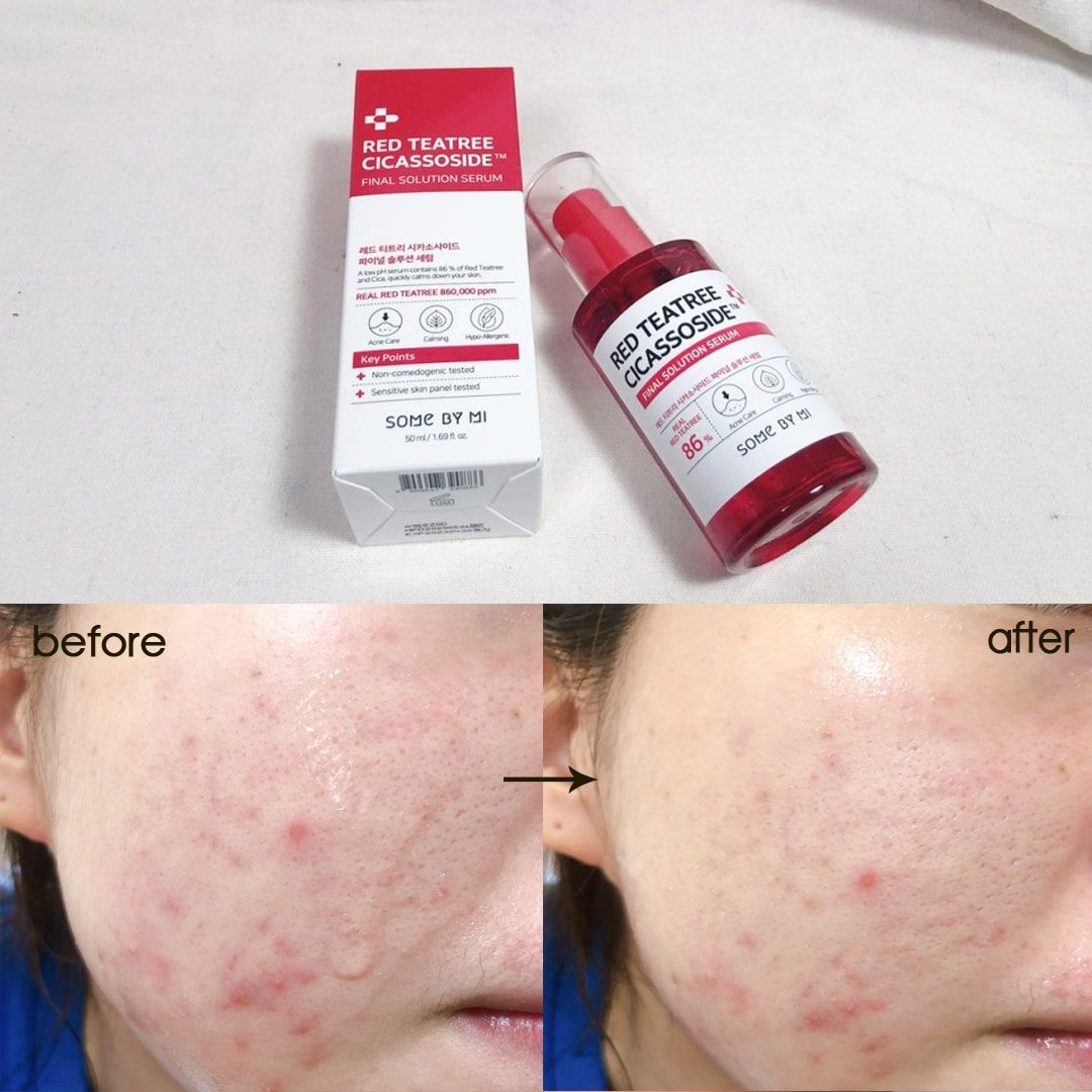 Tinh chất Tràm Trà Đỏ Some By Mi Red Teatree Cicassoside Final Solution Serum 50ml
