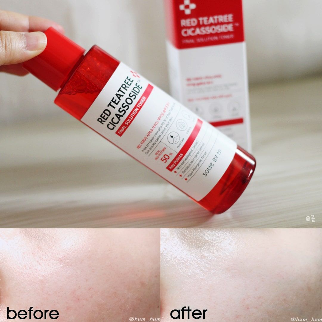 Nước Hoa Hồng Giảm Mụn Some By Mi Red Teatree Cicassoside Final Solution Toner