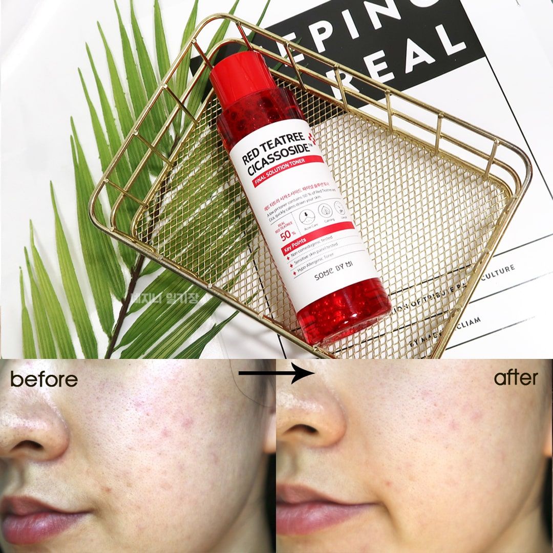 Nước Hoa Hồng Giảm Mụn Some By Mi Red Teatree Cicassoside Final Solution Toner
