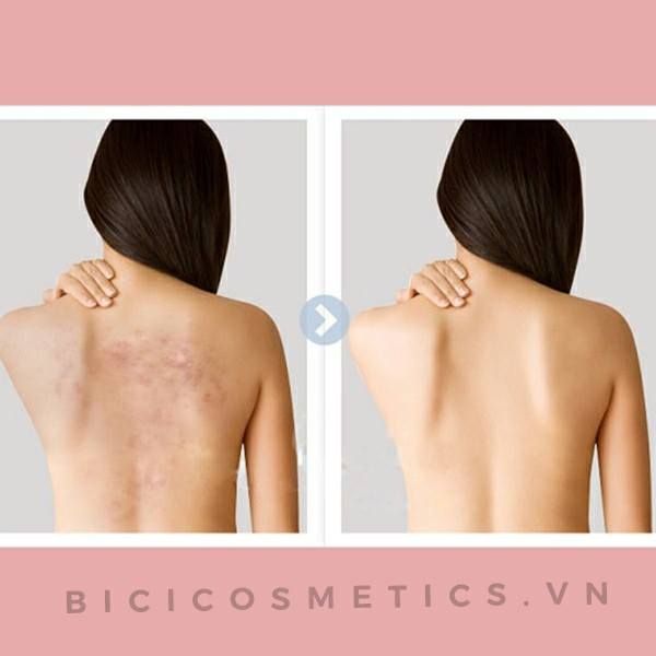 Xà Phòng Trị Mụn Lưng For Back Nhật