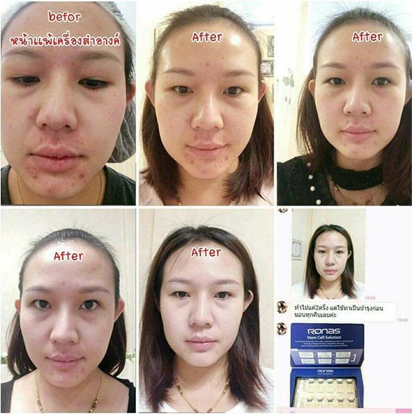 Tinh Chất Tế Bào Gốc Ronas Stem Cell Solution