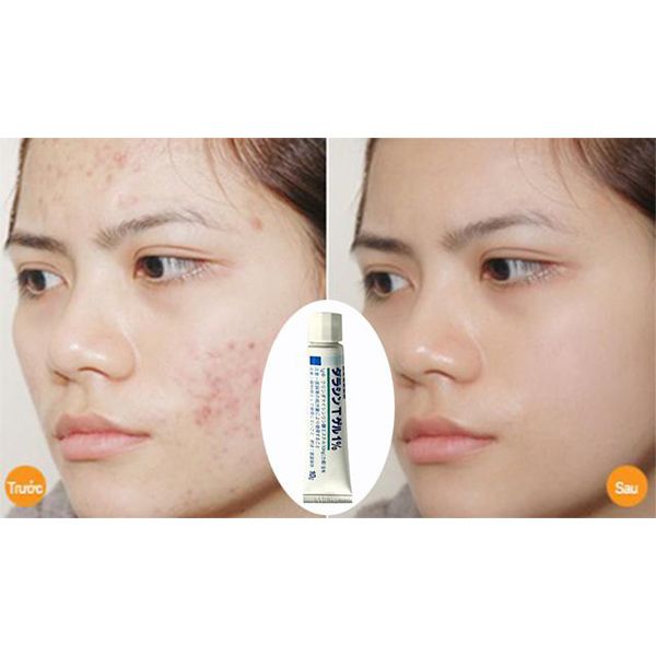 Kem Trị Mụn Dalacin T Gel 1%