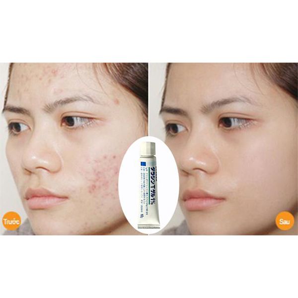  Kem Trị Mụn Dalacin T Gel 1% 