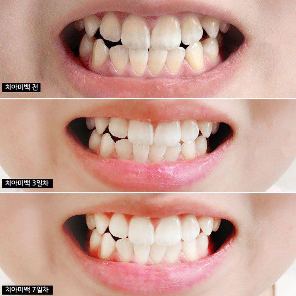 Kem đánh răng Median Dental IQ 93%