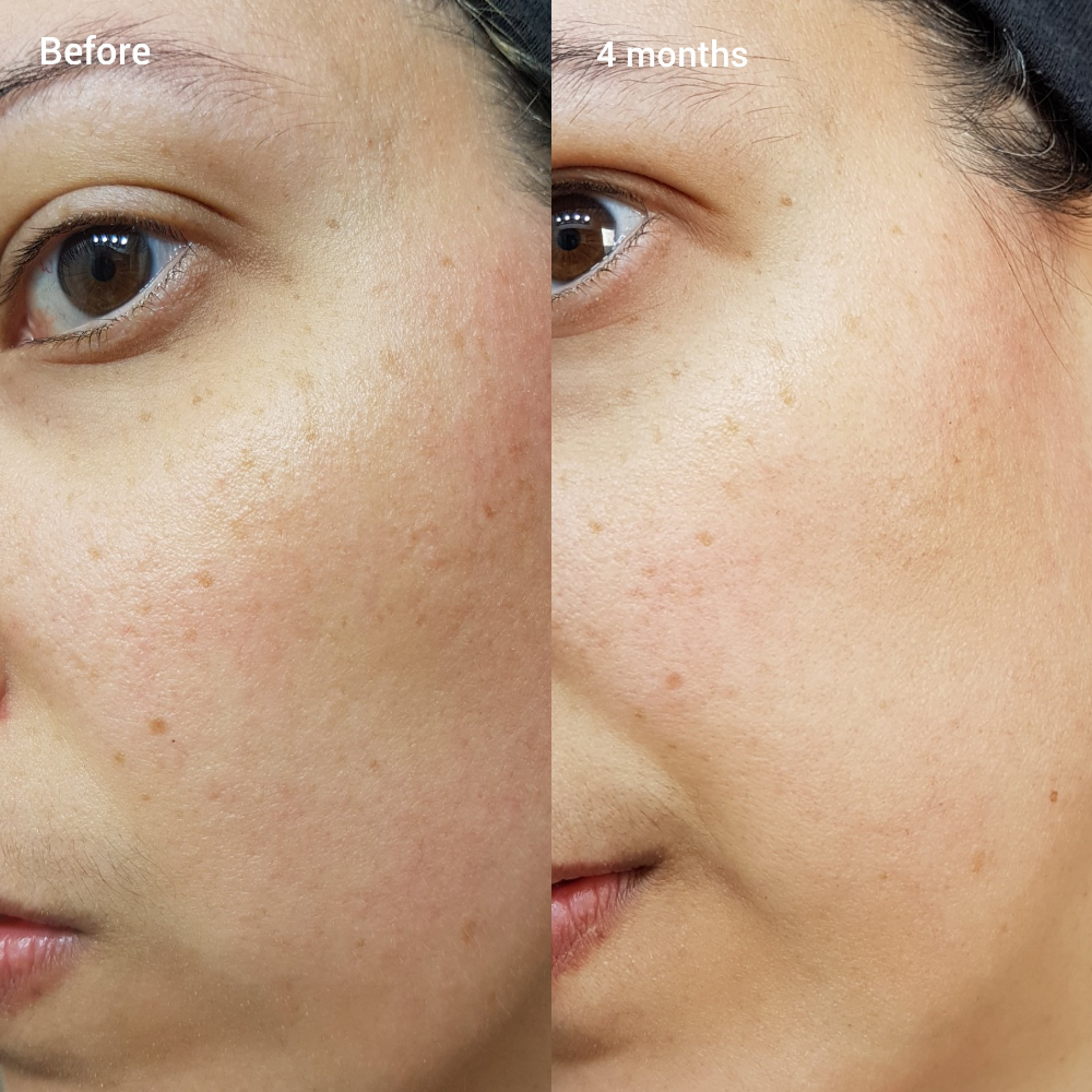 Serum The Ordinary Retinol 1% In Squalane Hỗ Trợ Chống Lão Hoá
