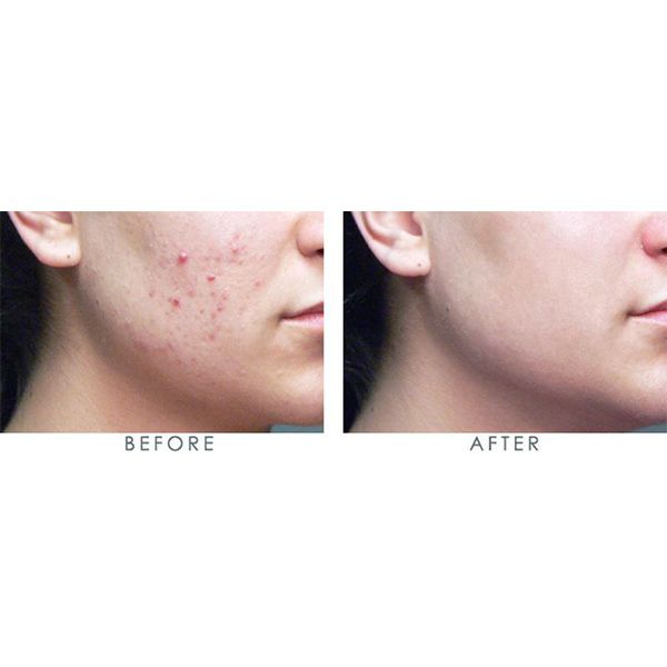 Kem Trị Mụn Dalacin T Gel 1%