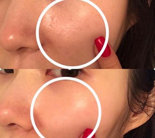 Serum Red Peel Tingle Serum -So’Natural