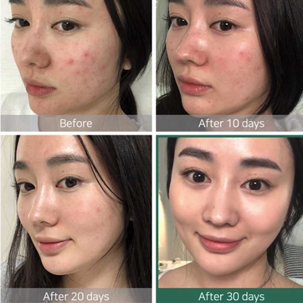 Set Trị Mụn Some By Mi AHA-BHA-PHA 30 Days Miracle AC SOS Kit Edition 4 Món