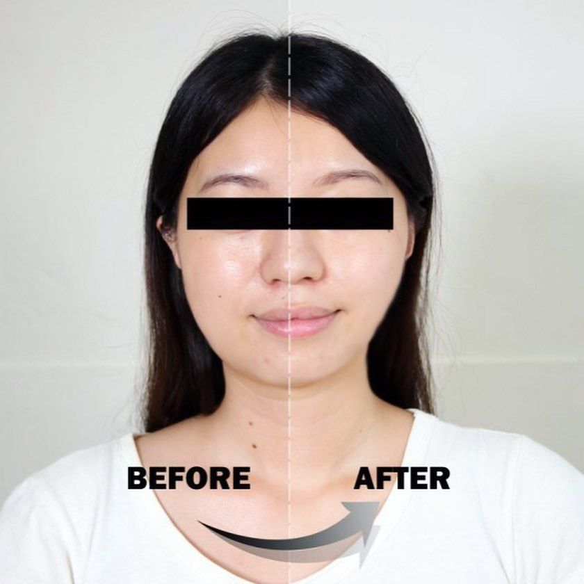 Thanh Lăn Massage, Nâng Cơ Mặt Wellderma Face Lifting Dark Silver Roller