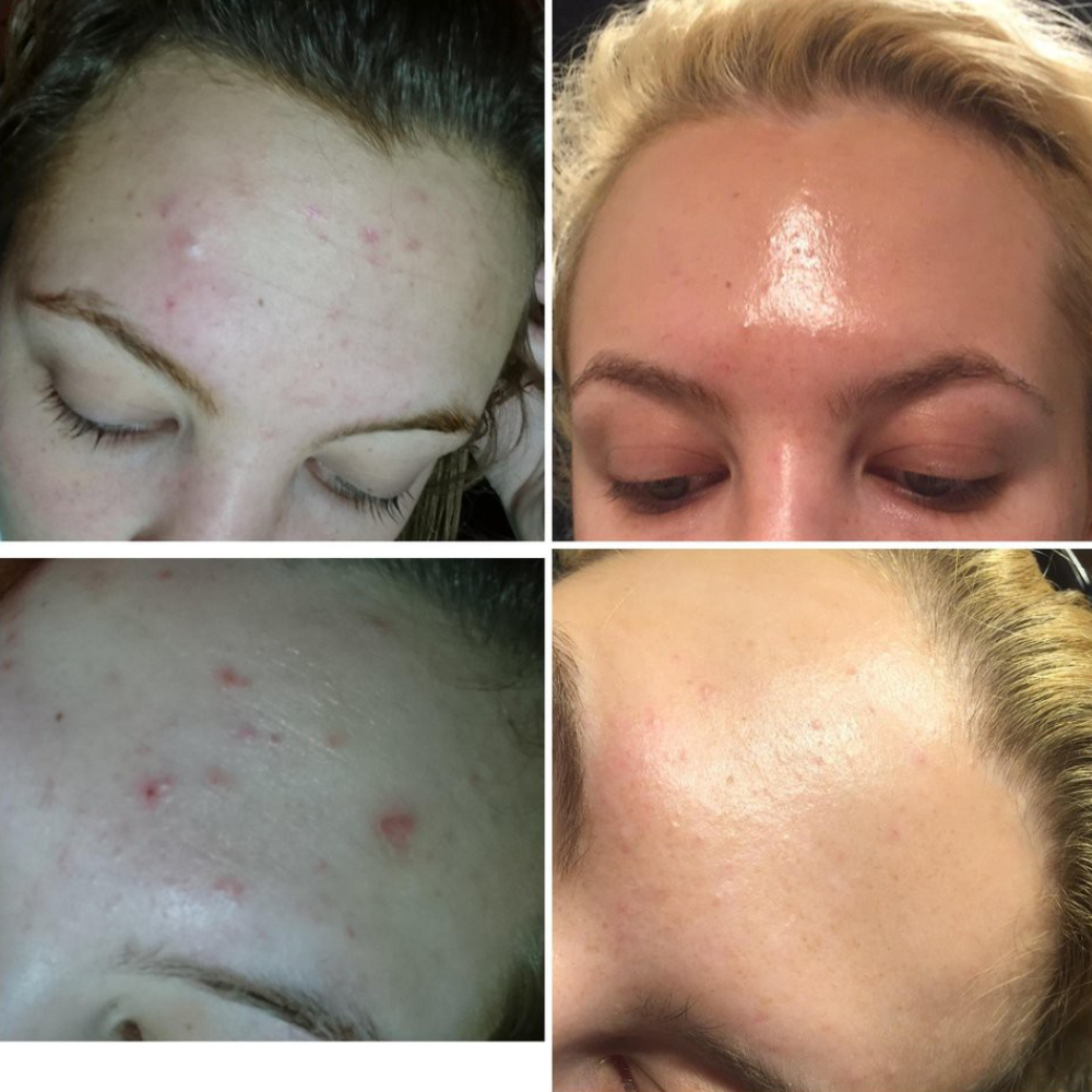 Serum The Ordinary Retinol 1% In Squalane Hỗ Trợ Chống Lão Hoá