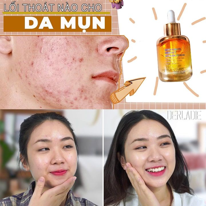 Tinh Chất Trị Mụn Derladie Witch Hazel Perfect Vitamin Serum (35ml)